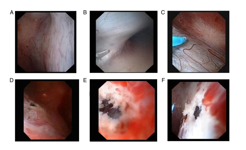 Ultrasonography‑assisted flexible ureteroscope for the treatment of parapelvic renal cysts: A comparison between the 1470‑nm diode laser and the holmium laser